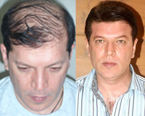 Aditya Pancholi Hair Transplant Surgery