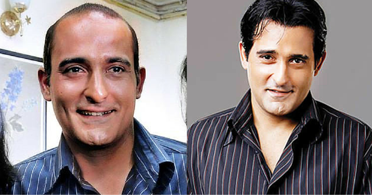 Akshaye Khanna Hair Transplant