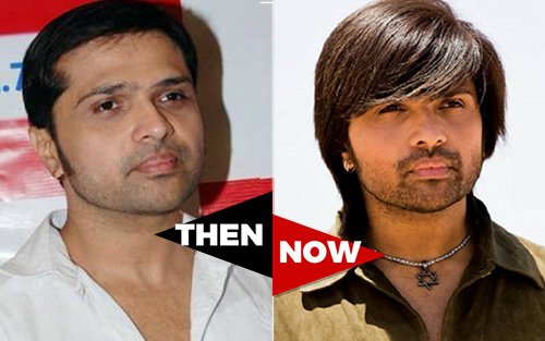 Himesh Reshammiya Before and After Hair Transplant