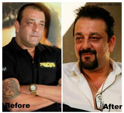 Sanjay Dutt Hair Transplant